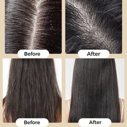 Хагны эсрэг шампунь