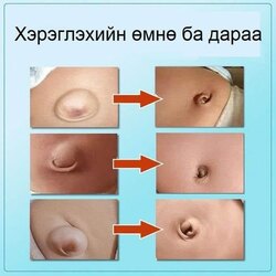 Хүйн эвэрхийн наалт