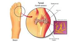 Шээсний хүчил хөөх бэлдмэл