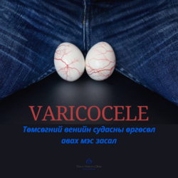 Варикоцел хагалгаа