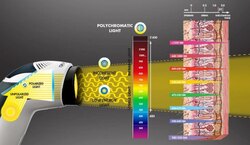 Bioptron шарлага эмчилгээ