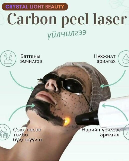 Carbon peel laser 
