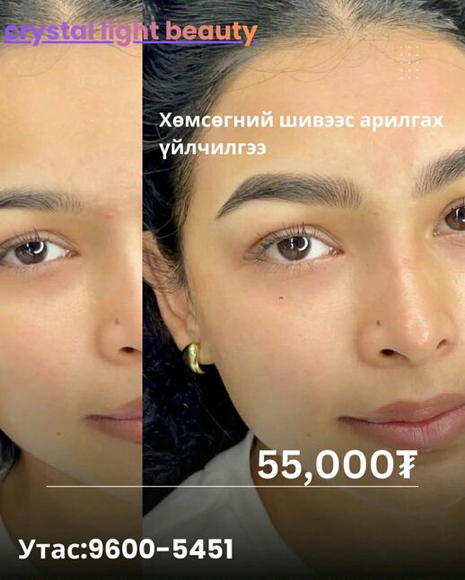 Хөмсөгний шивээс арилгах үйлчилг